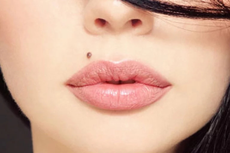 همه چیز درباره برداشتن خال
