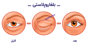 Blepharoplasty