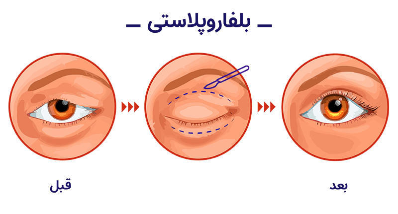 Blepharoplasty Blepharoplasty