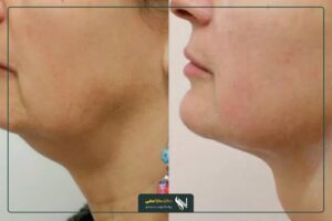عکس قبل و بعد هایفوتراپی